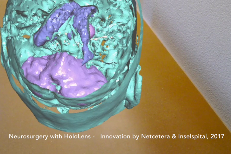 3-D Visualisierung eines Hirntumors mit der HoloLens